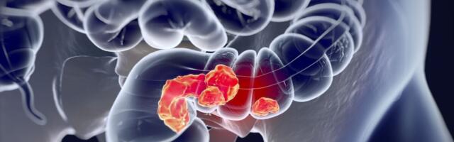 Laura Roht kaitseb väitekirja pärilikest kolorektaalvähi sündroomidest Eestis