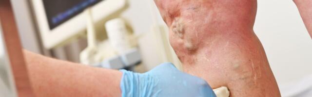 Venoosne tromboos – haigus vereringe “unustatud” osas