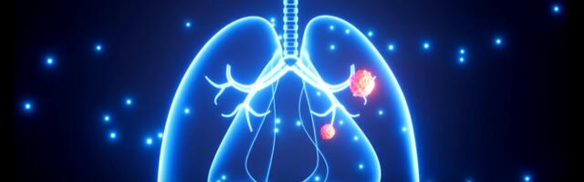 "Impulss": kopsuvähi sõeluuring aitab avastada haigust õigel ajal