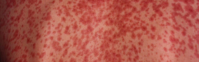 Eestis tuvastati taas leetrijuhtum