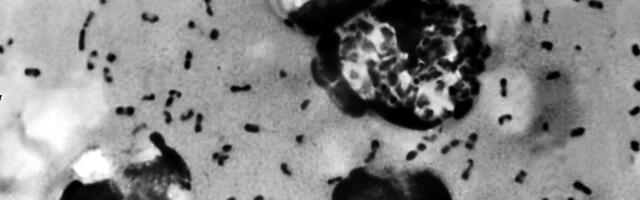 California elanikul diagnoositi katk