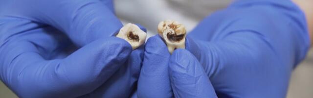 Nähtamatu liikumine võib määrata hambatäidise vastupidavuse