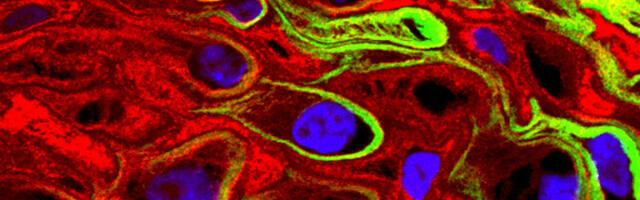 Emakakaelavähi riski mõjutavad HPV alatüüp ja naise vanus