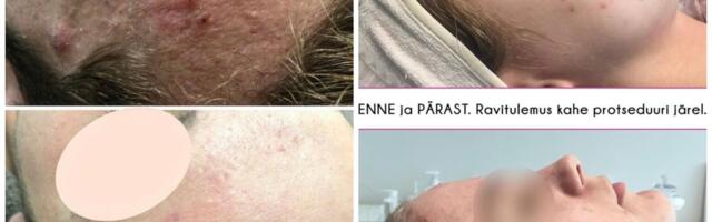 Miks valida happekoorimine?