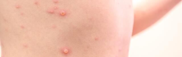 Euroopas tuleb üha enam teateid ahvirõugete levikust, Eestis juhtumeid teada pole