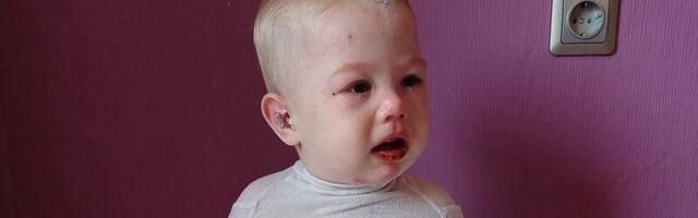 Pisikese Myroslavi keha on kaetud villidega: palun aita soetada ravigeel, mis parandab haavu ja leevendab valu