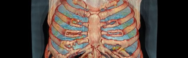 3D VIDEO | Seda teeb koroonaviirus kopsuga