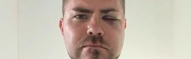 Baltic Pride’i ajal Tallinnas kallaletungi ohvriks langenud soomlane vajas näooperatsiooni