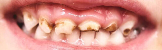 Soomes sai kohtulikult karistada laste hambad hooletusse jätnud ema, hambaid tõmmatakse välja juba 2-aastastel lastel