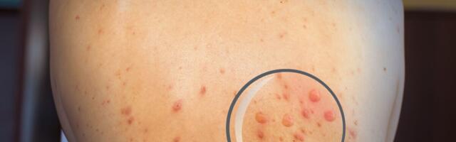 Lätis kinnitati esimene ahvirõugete juhtum