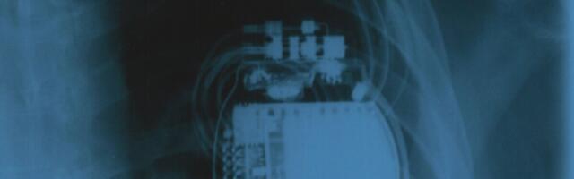 Väitekiri: diabeetiku südamestimulaatorist saadav kasu on piiratud