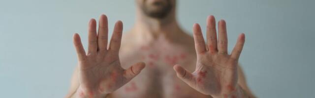 Erinevalt Euroopast ei ole ahvirõuged Aafrikas  koodnunud vaid geide kogukonda