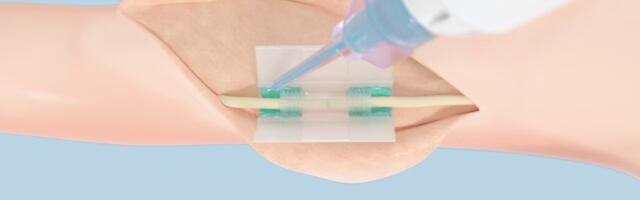 FDA clears path for Paris startup TISSIUM's tissue reconstruction without sutures, redefining surgical standards