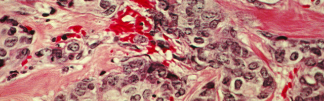 Miks vähirakud nii palju energiat raiskavad? Vastus võib aidata leida uusi vähiravimeid