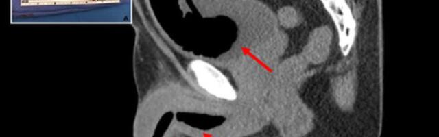 Impotendi partner muutis mehe peenise isolatsioonivahuga kasutuskõlbmatuks