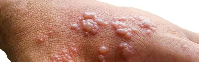 Eestis diagnoositi järgmine ahvirõugejuhtum