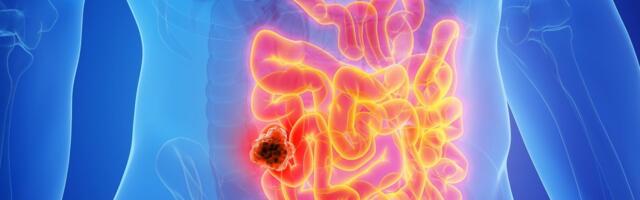 Haruldast vähki diagnoositakse üha rohkem. Selle taga on üllatav rahaline põhjus