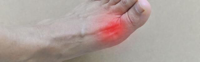 Teadlased: podagraatakk seostub suurema infarktiohuga