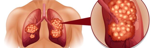 Kopsuvähi sagedasim kaasleid on koronaarateroskleroos