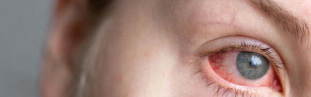 Silmad kipitavad ja sügelevad? Apteeker annab nõu, kuidas vaevusi edukalt leevendada