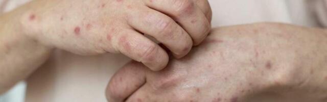 Masalu uzliesmojumā saslimušo skaits pieaudzis līdz 31