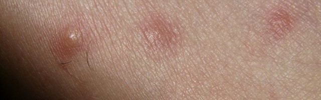 Tüütu kaaslane allergia: kurgus poob ja rinnus pigistab!