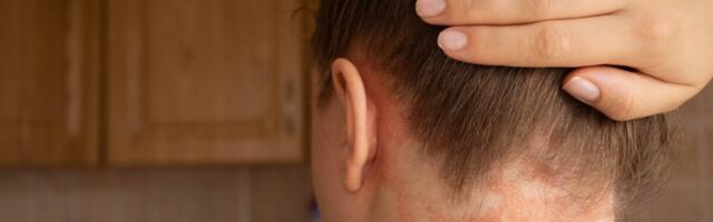 Psoriaasi saab raviga kontrolli all hoida