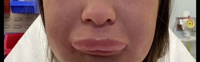 Naine kaebab, et näeb peale huuletäite eemaldamist välja nagu Homer Simpson