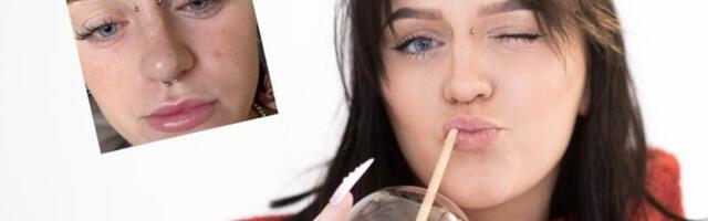 „Päris jube oli olla. Ma ei saanud hommikul silmi lahti teha!“ Läbitud iluprotseduur tekitas Mariliis Kaerale kannatusi