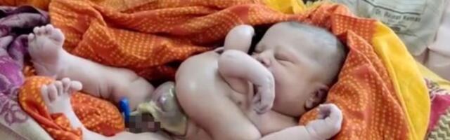 Indias sündis nelja käe ja nelja jalaga laps
