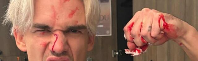 Muusik Rozell murdis padelit mängides ninaluu. „Lõin ise endale reketiga näkku“