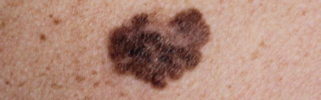 Doktoriväitekiri: Infrapuna võib töötada kõige surmavamate nahavähkide diagnostikas