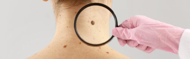 Soome ekspert on mures melanoomidiagnooside arvu languse pärast