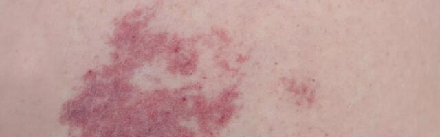 Uuring: Sidekoerakud mõjutavad veresoonte väärarengute kasvu