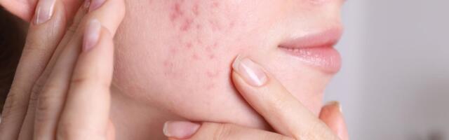Raske akne võib endaga kaasa tuua armistumise. Millal pöörduda arsti poole?