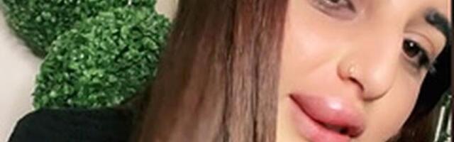 Naine saadeti ilusalongist vaid osaliselt suurendatud huulega minema