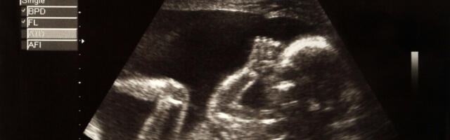 Tartu Ülikooli teadlased avastasid uue geeni, mis põhjustab loote väärarenguid