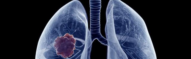 Need viis muutust kehas võivad olla surmava kopsuvähi tunnusteks