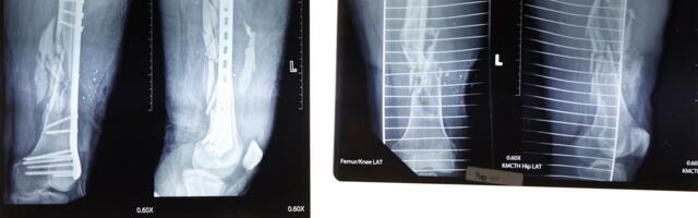 Hiinlased lõid „superliimi“ luude jaoks. See parandab murrud vaid loetud minutitega