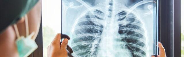 Mida tähendab kopsuvähi sõeluuringu positiivne leid?