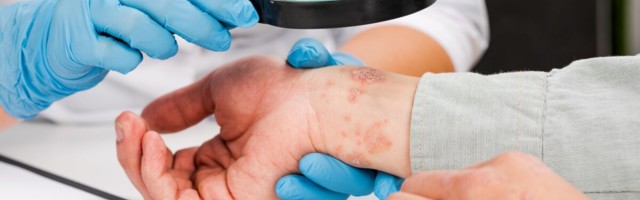Psoriaasihaige käsitlus – lokaalne ja süsteemne ravi