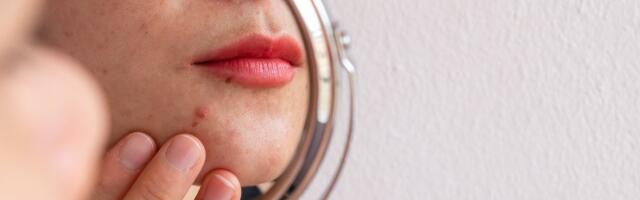 Ei šokolaadile ja piimatoodetele? Viis müüti akne kohta, mida ei pea enam uskuma