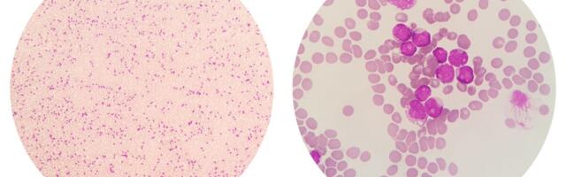 Äge müeloidleukeemia