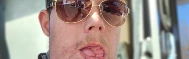 Haruldase haigusega mees pidi valima oma näo ja hääle vahel