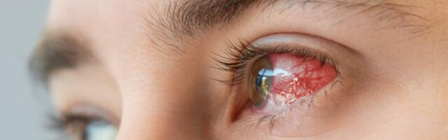 Paarkümmend Tallinna silmakliiniku patsienti nakatus protseduuri tõttu silmapõletikku