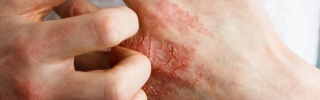 Raskekujulise atoopilise dermatiidi bioloogiline ravi täiskasvanutel