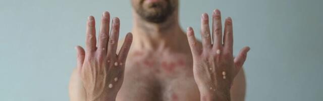 Ahvirõugete vaktsiin saabub Eestiss juuli lõpus