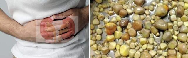 Neerukivid ja kuidas nendest vabaneda koduste vahenditega.