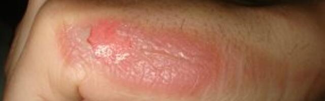 Teadlased selgitasid välja, kuidas tuleõnnetustes saadud põletused tõukasid inimese evolutsiooni tagant