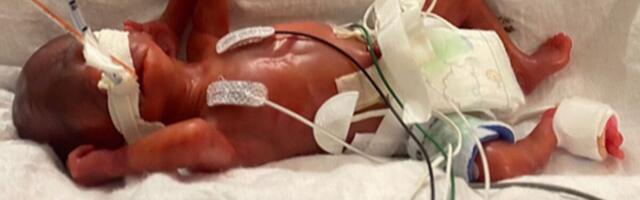 Maailma enneaegseimalt sündinud beebi nägi ilmavalgust 21. nädalal